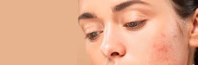 Skincare Treatments for Sensitive Skin: What Works and What to Avoid