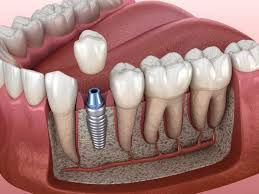 How Implant Dentistry Combines Aesthetics With Functionality
