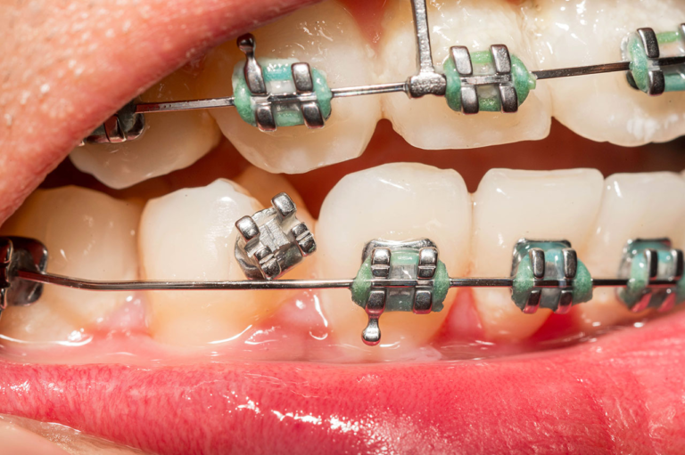The Role Of Orthodontics In Reducing Dental Emergencies